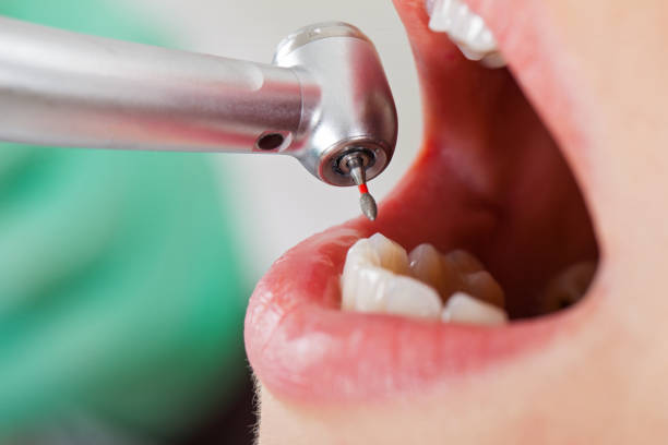 Best Knocked-Out Tooth (Avulsed Tooth) Treatment in Bedford Hills, NY